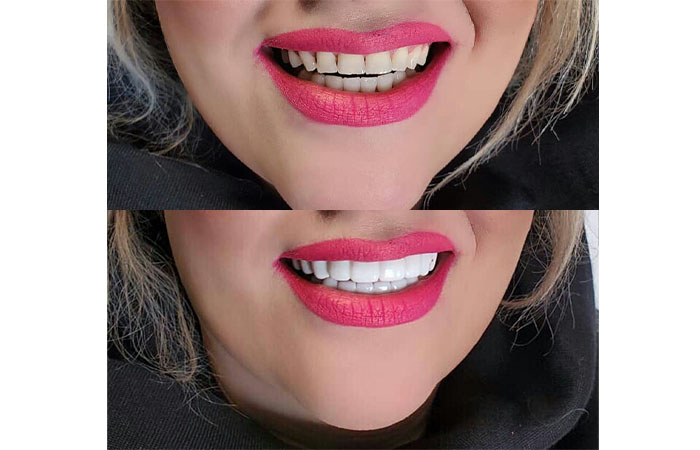 لمینت متحرک دندان اسنپ آن اسمایل snap on smile سفید کننده و منظم کننده دندان